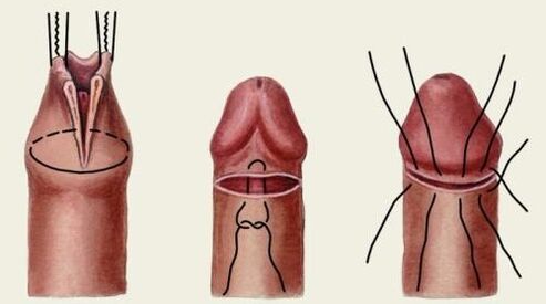 Come viene eseguita la chirurgia plastica del pene