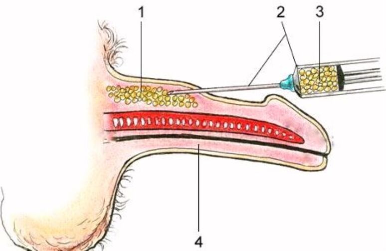 ingrandimento del pene tramite iniezione